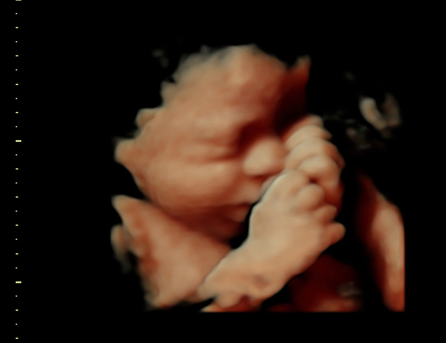 3D ultrasound image at 31 weeks